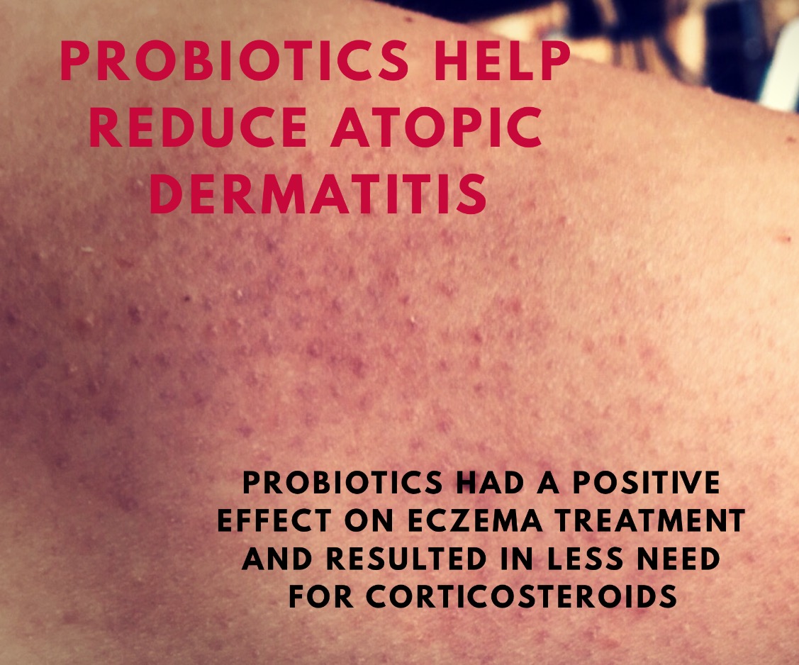 Probiotics For Eczema